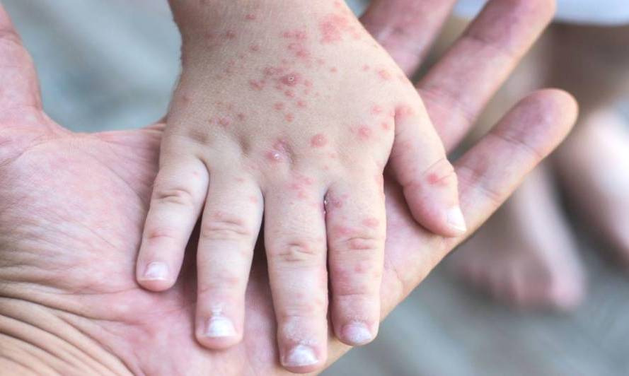 o sarampo é uma doença infecciosa grave, causada por um vírus, e pode levar à morte. Foto ilustrativa